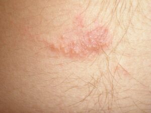 Krätze Scabies roter Fleck auf der Haut