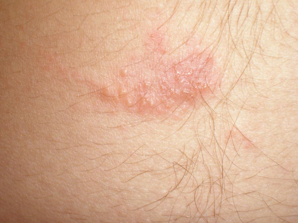 Krätze Scabies roter Fleck auf der Haut