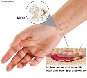 Krätzemilben Scabies