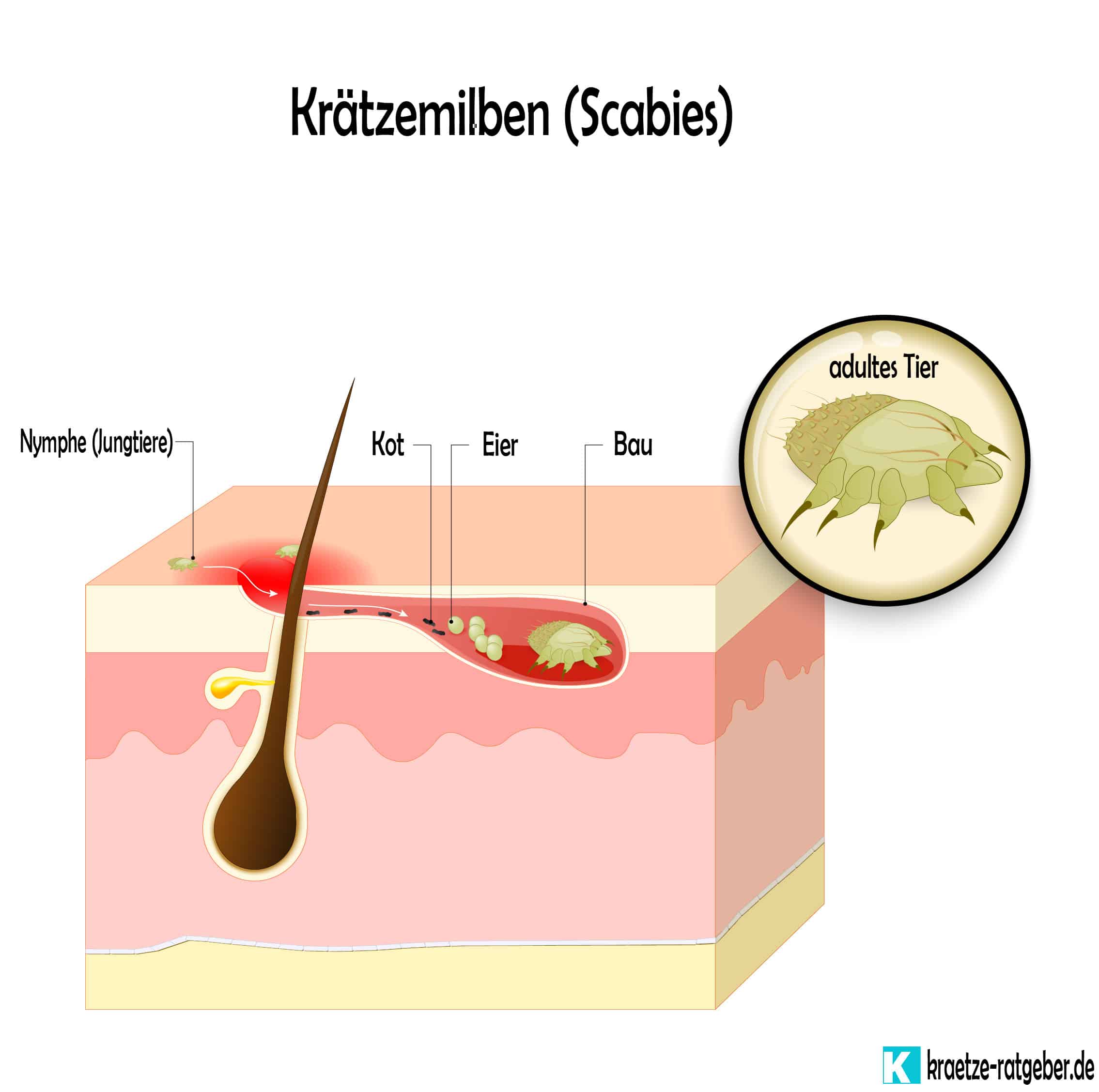 Krätzemilben Erklärung